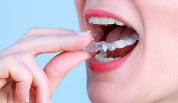 Knirschschiene - speziell für Sie angepasst